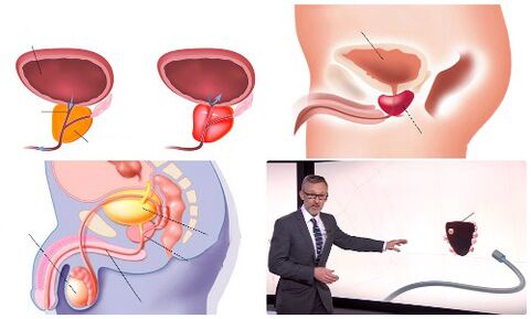 healthy and sick prostate